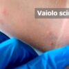 Oms: Vaiolo scimmie, “è emergenza sanitaria globale”