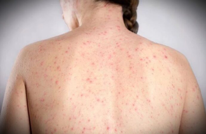 Morbillo, dagli aeroporti Usa alle scuole di Londra: dilagano gli alert